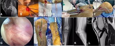 The tibial insertion of the hamstring can be considered to be preserved during anterior cruciate ligament reconstruction